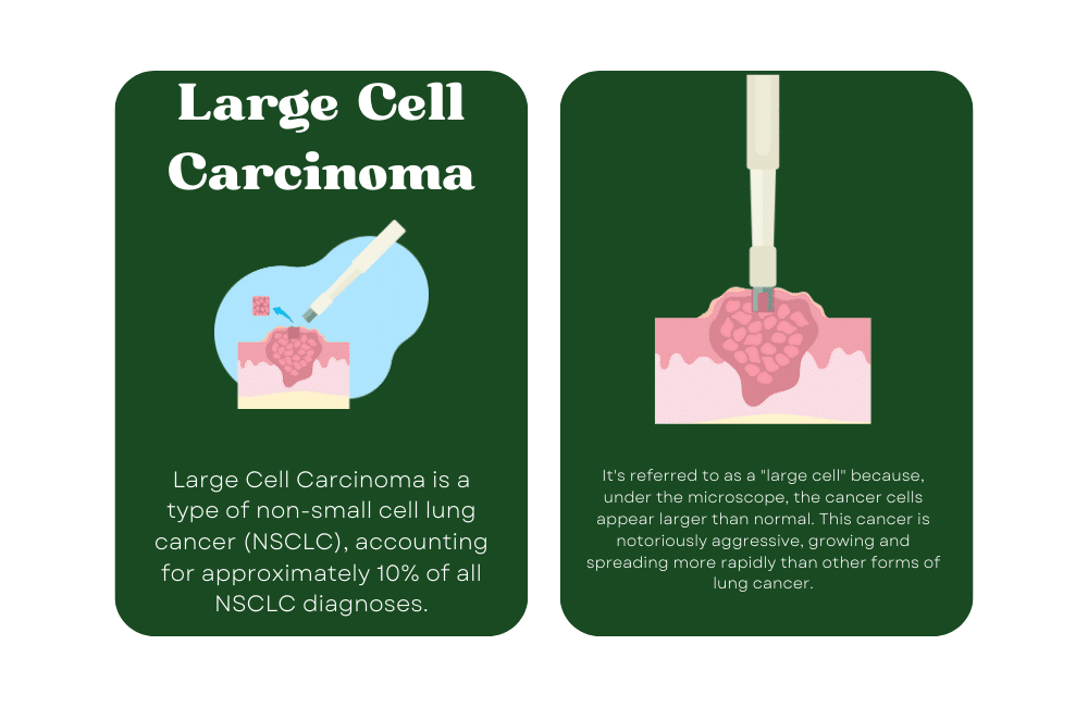 an illustration of a What is Large Cell Carcinoma?