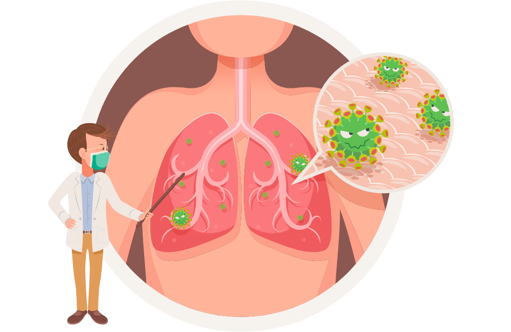 an illustration of a Pneumonia: Understanding and Effective Treatment.